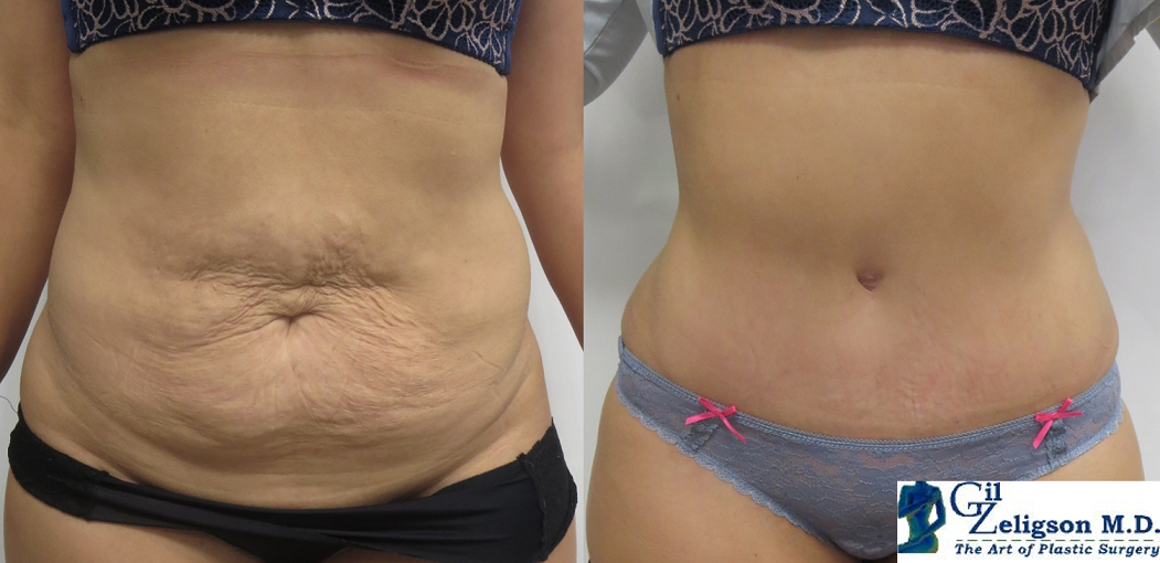   Lipoabdominoplasty - Dr. Gil Zeligson