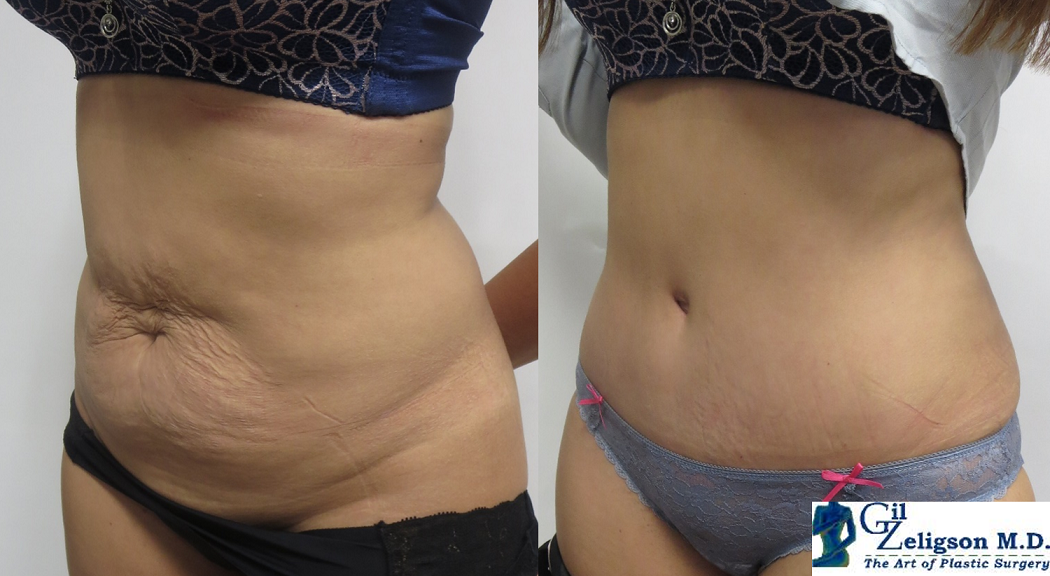   Lipoabdominoplasty - Dr. Gil Zeligson