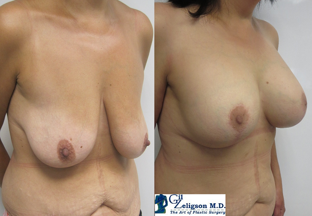 Dr. Gil Zeligson - Mastopexy + Augmentation