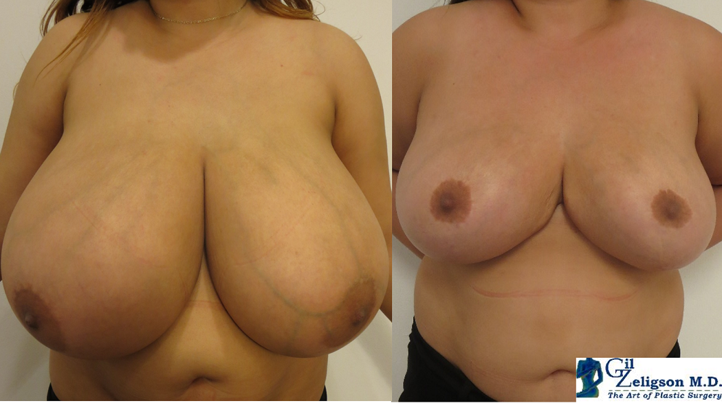 HUGE BREAST REDUCTION - DR. GIL