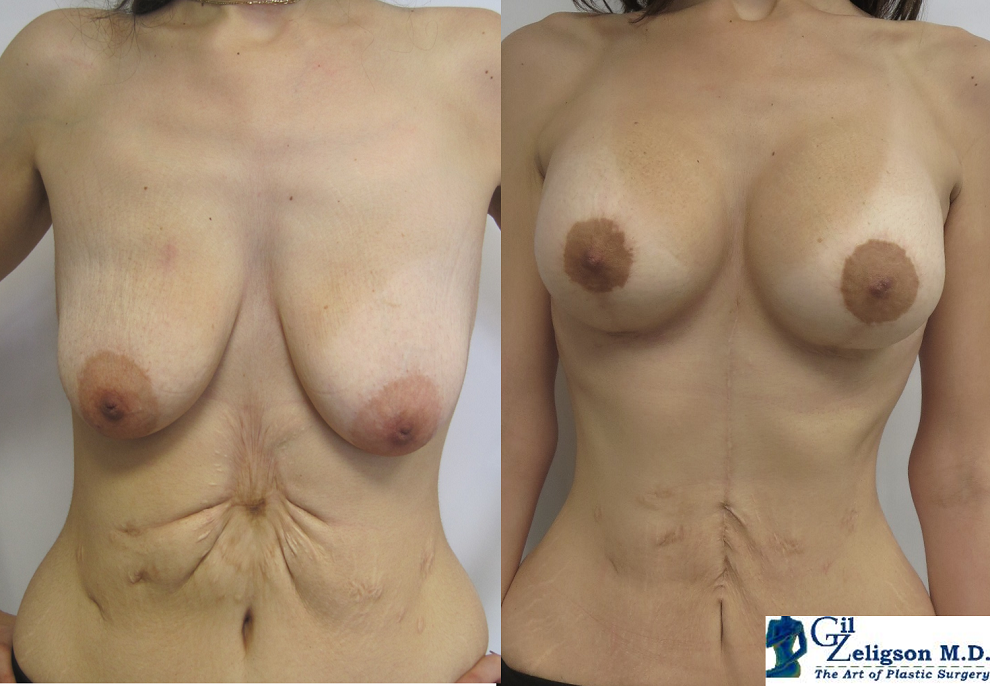Dr. Gil Zeligson - Mastopexy + Augmentation