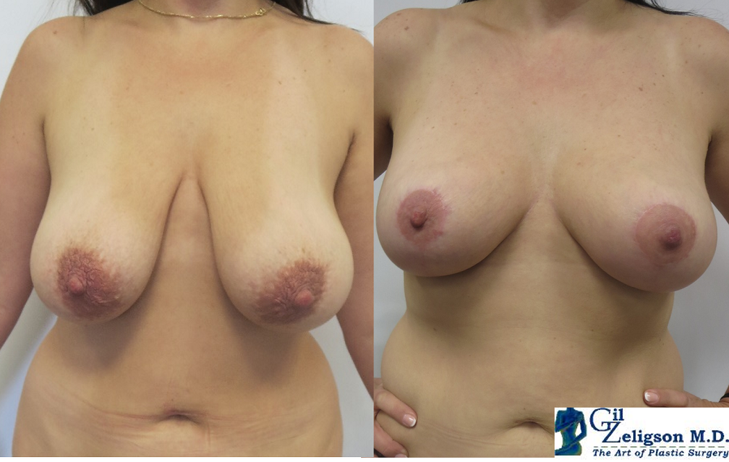 הרמת חזה MASTOPEXY -DR. GIL