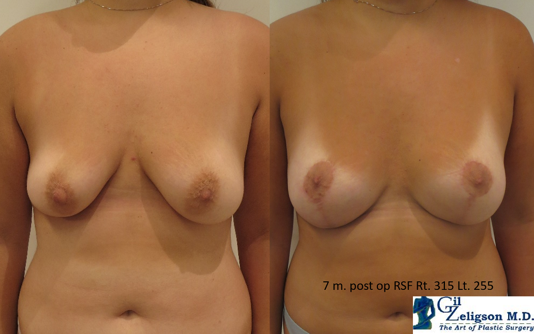 Dr. Gil Zeligson - Mastopexy + Augmentation