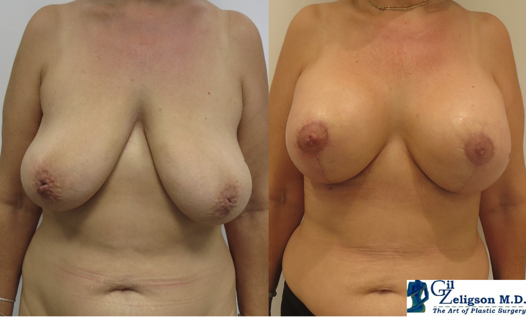 Dr. Gil Zeligson - Mastopexy + Augmentation