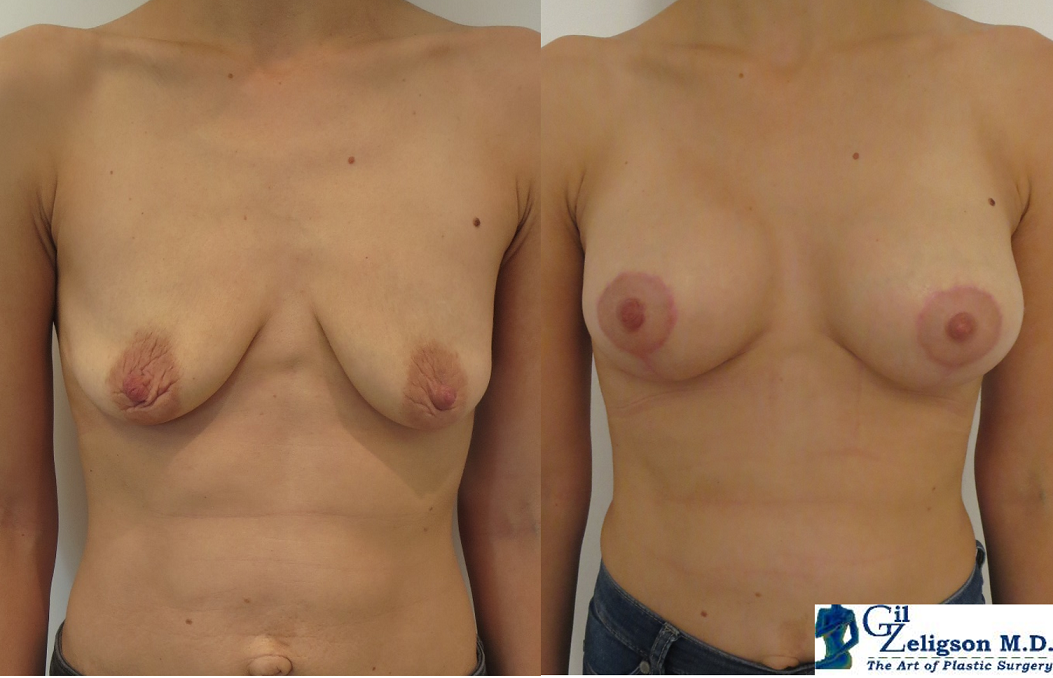 Dr. Gil Zeligson - Mastopexy + Augmentation