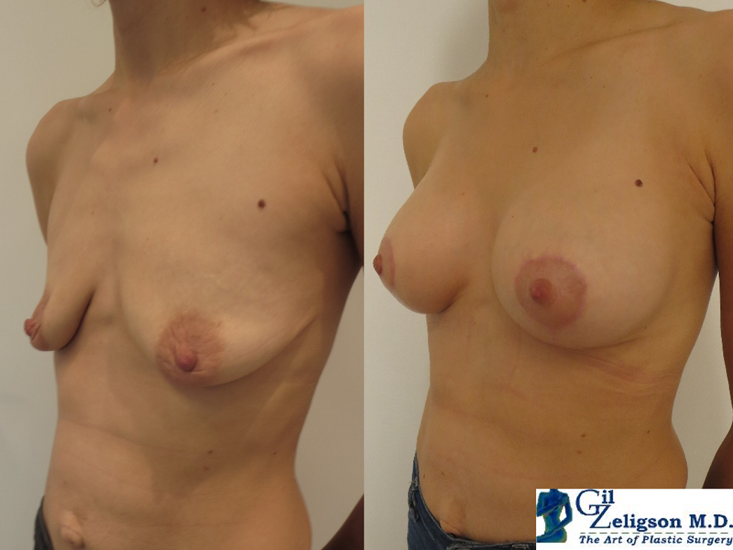Dr. Gil Zeligson - Mastopexy + Augmentation