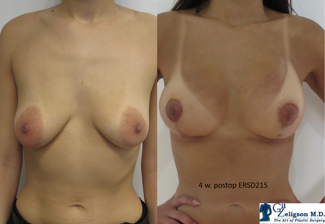 Dr. Gil Zeligson - Mastopexy + Augmentation