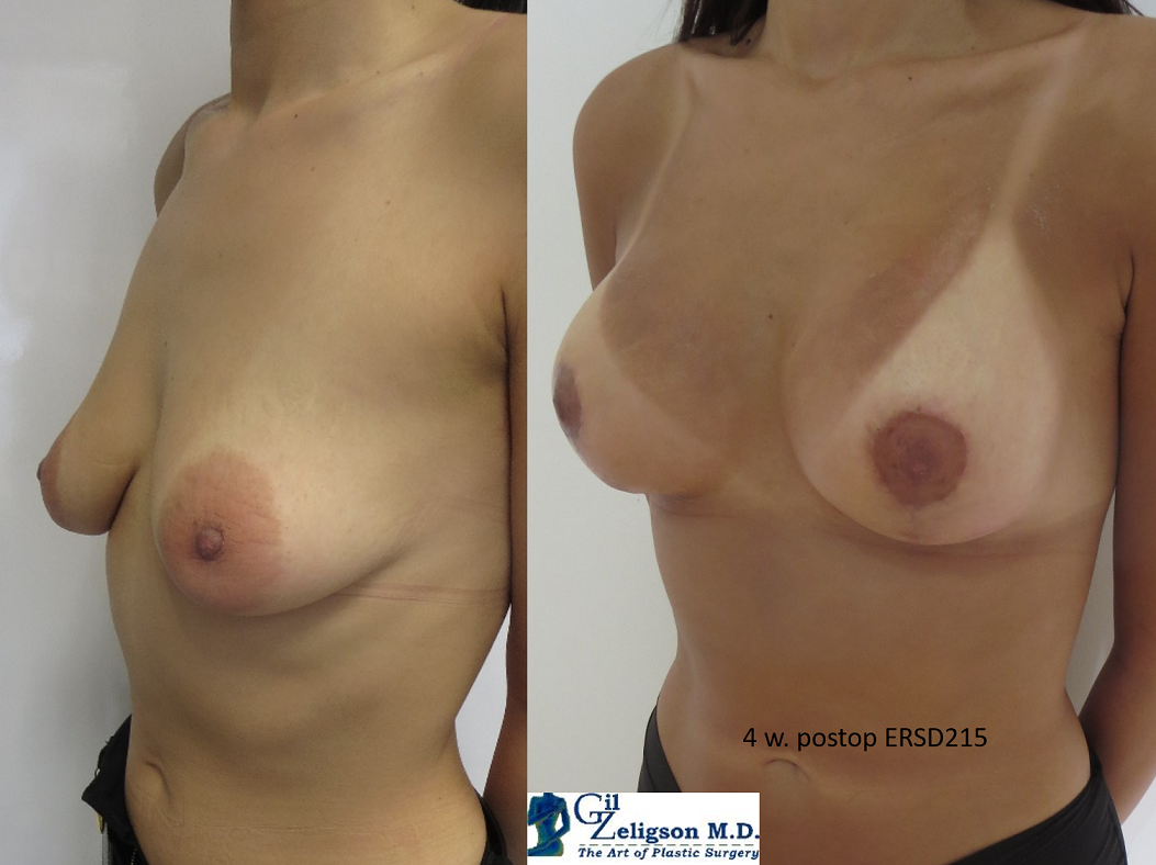 Dr. Gil Zeligson - Mastopexy + Augmentation