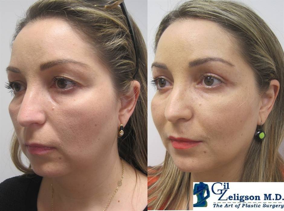 הרמת עפעפיים מחיר