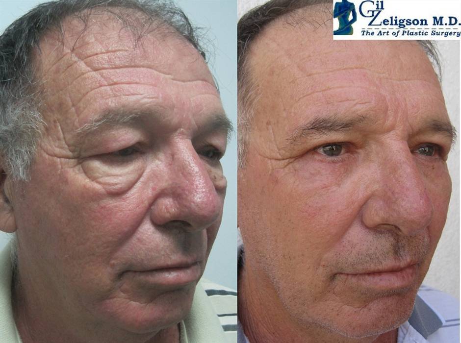 הרמת עפעפיים מחיר