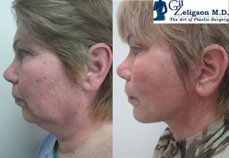 מתיחת פנים מחיר