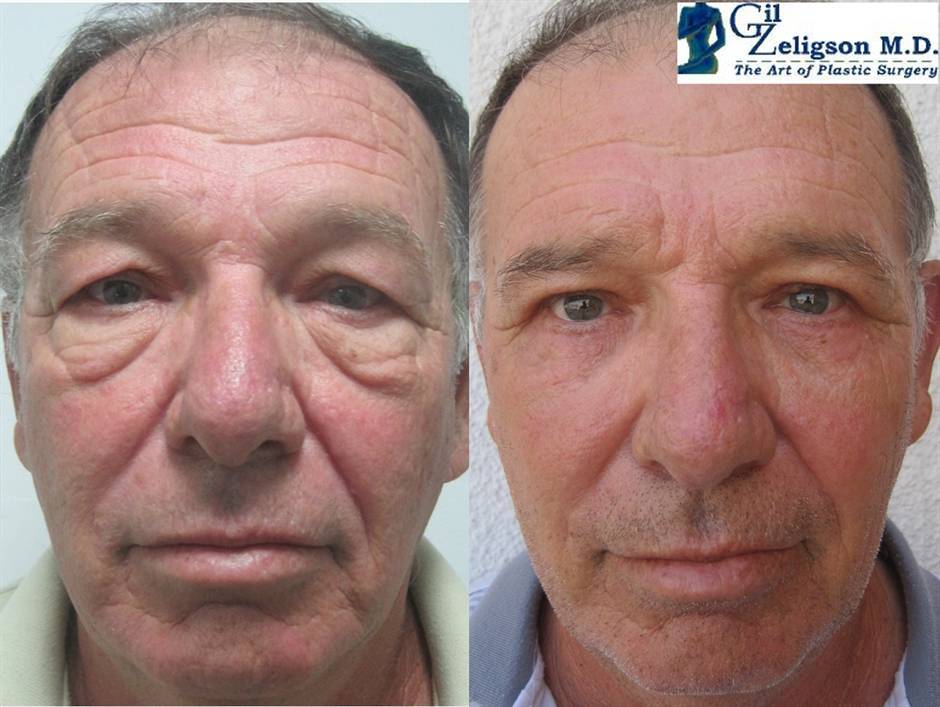 הרמת עפעפיים מחיר