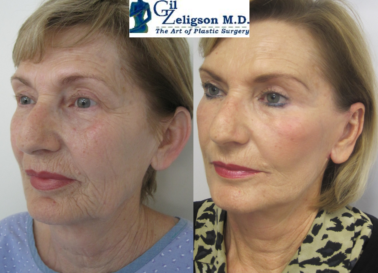 מתיחת פנים מחיר