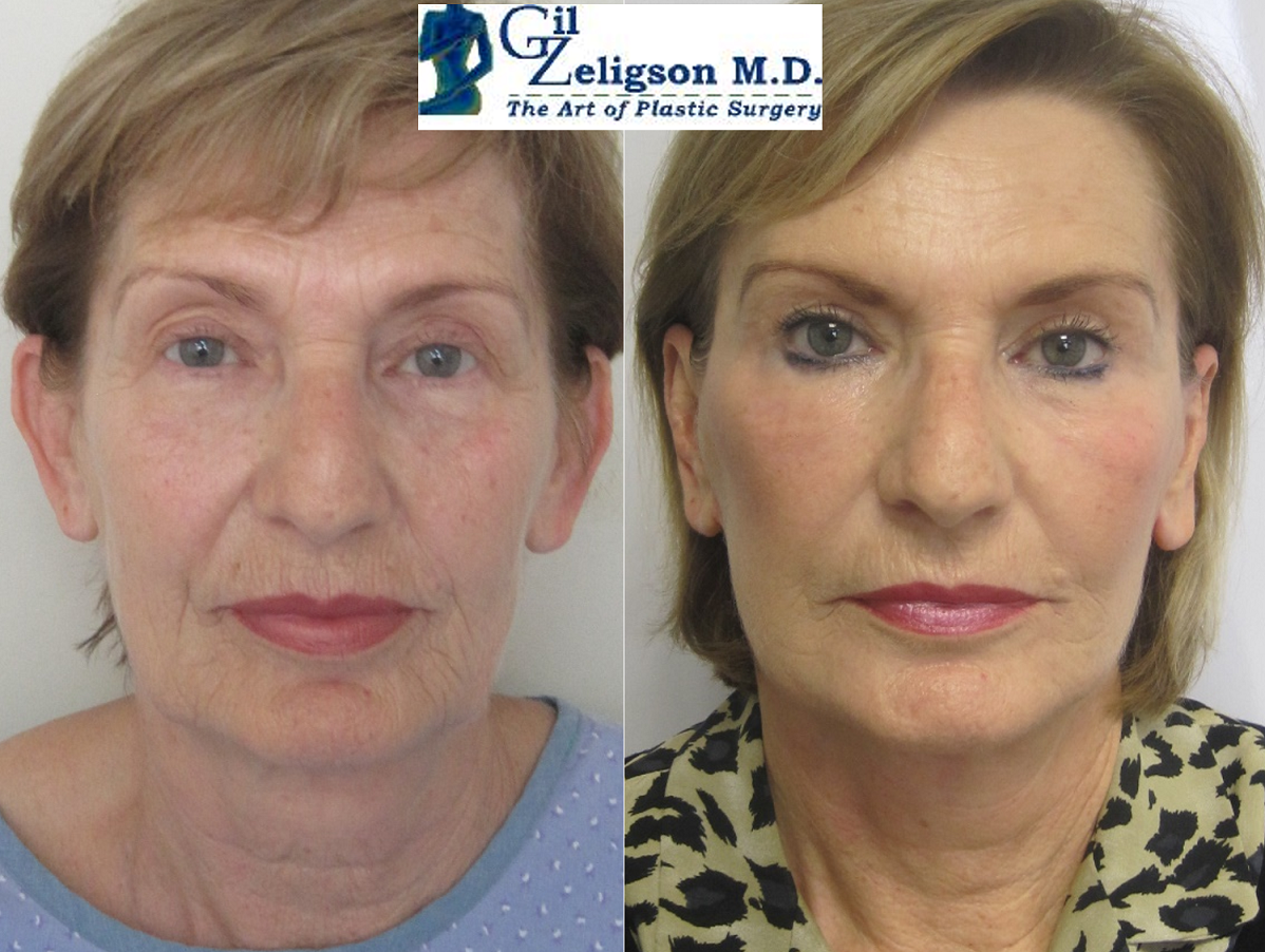 מתיחת פנים מחיר