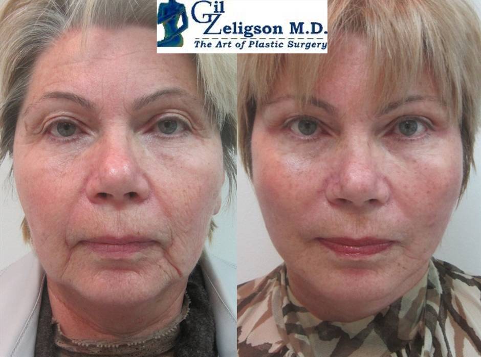 מתיחת פנים מחיר